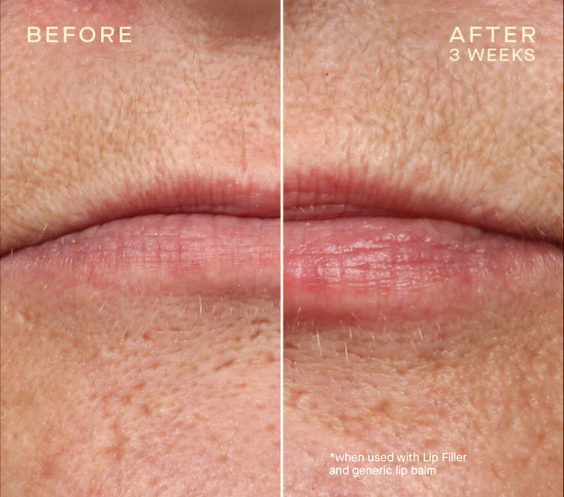 Lip Filler with Subtopical Plumping Technology™